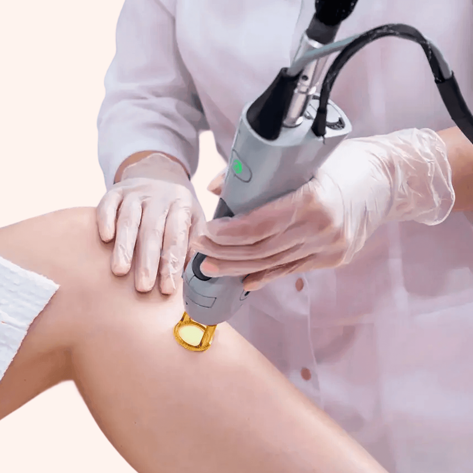 Laser Hair Removal