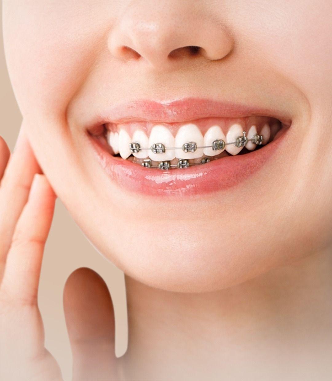 Dental Braces