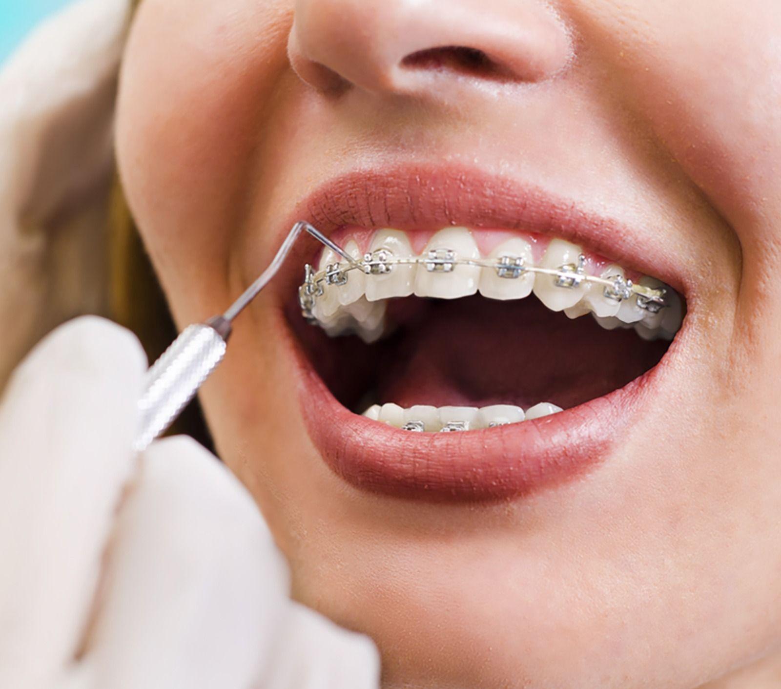 Dental Braces