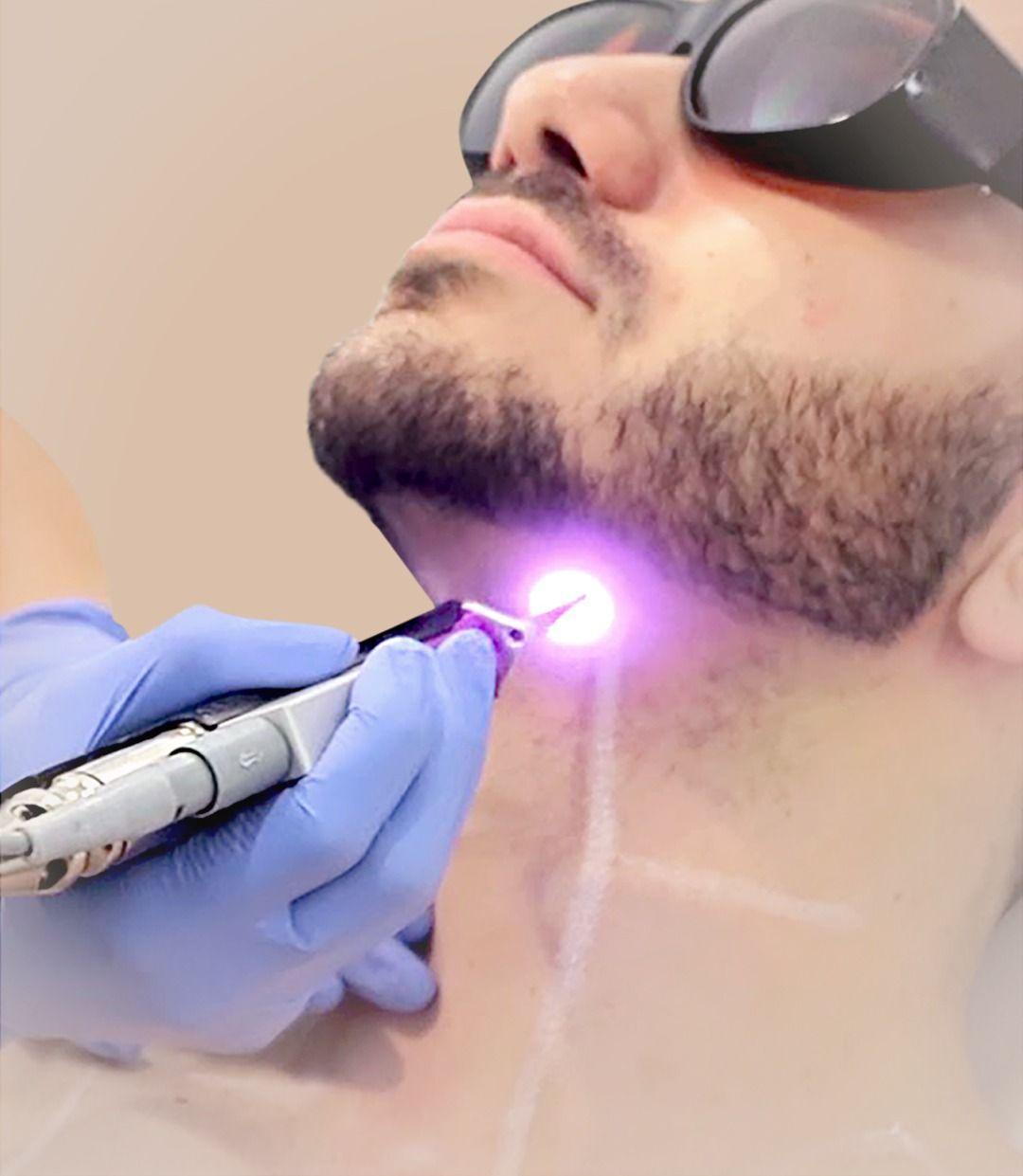 Laser Beard Line