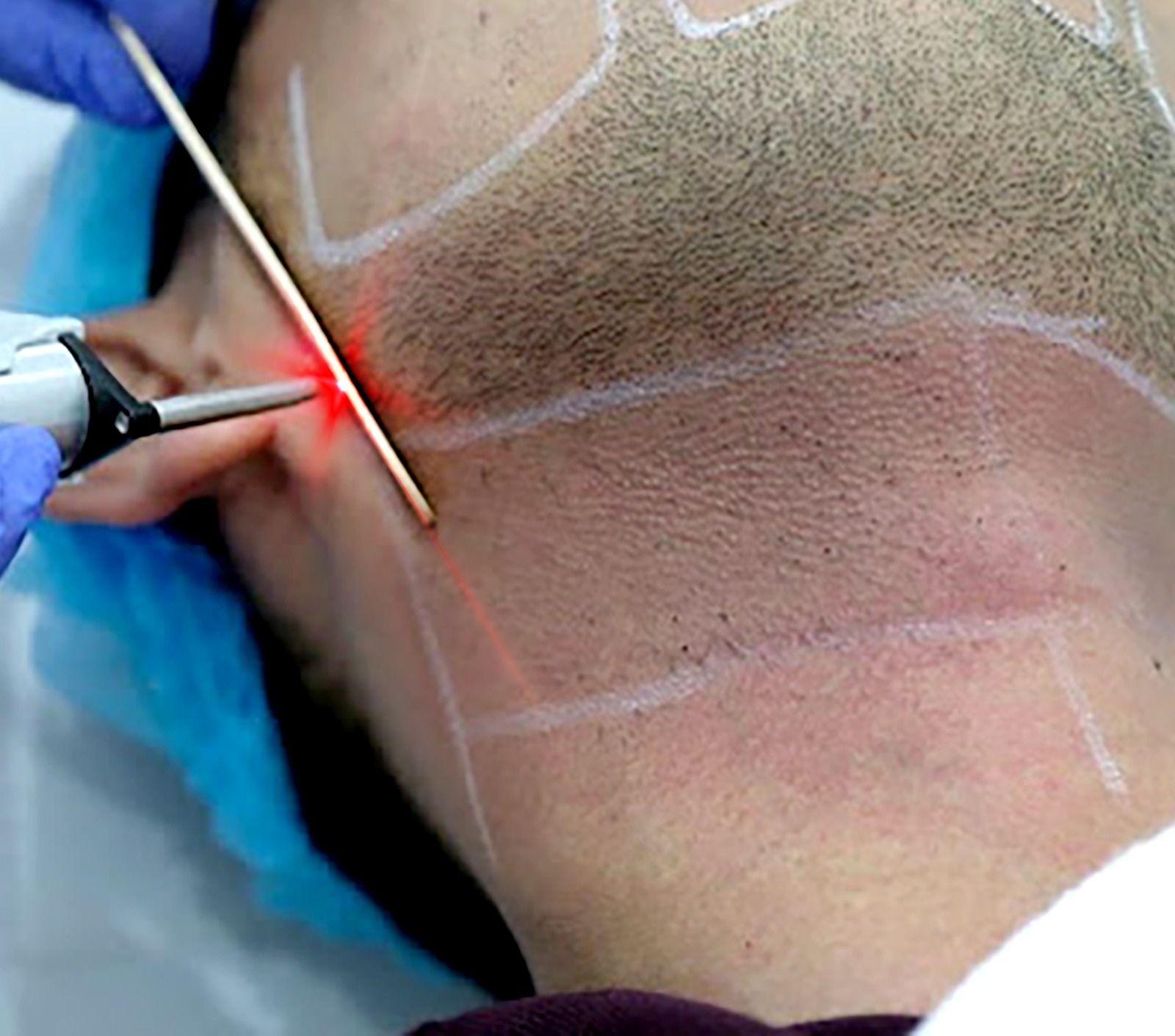 Laser Beard Line
