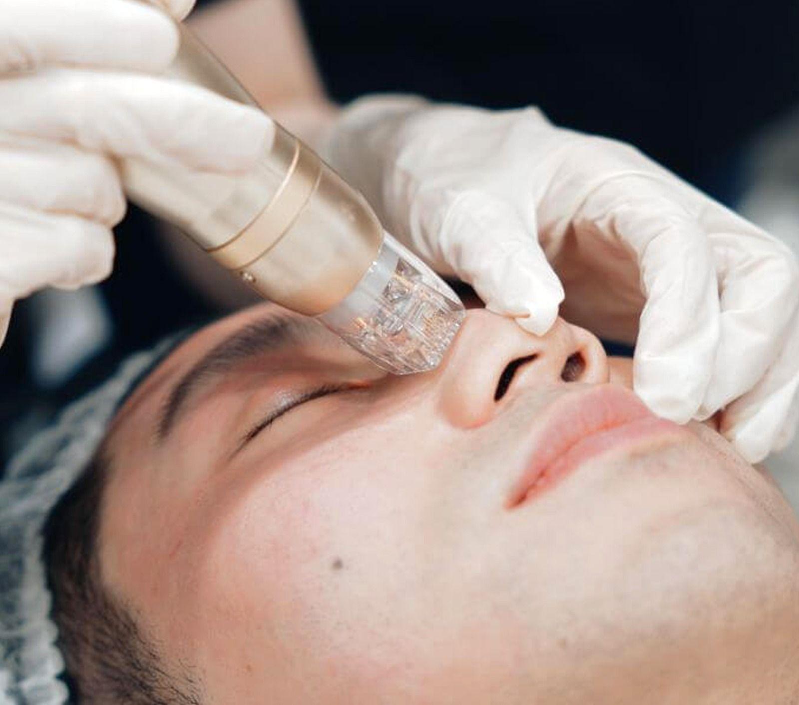 Microneedling