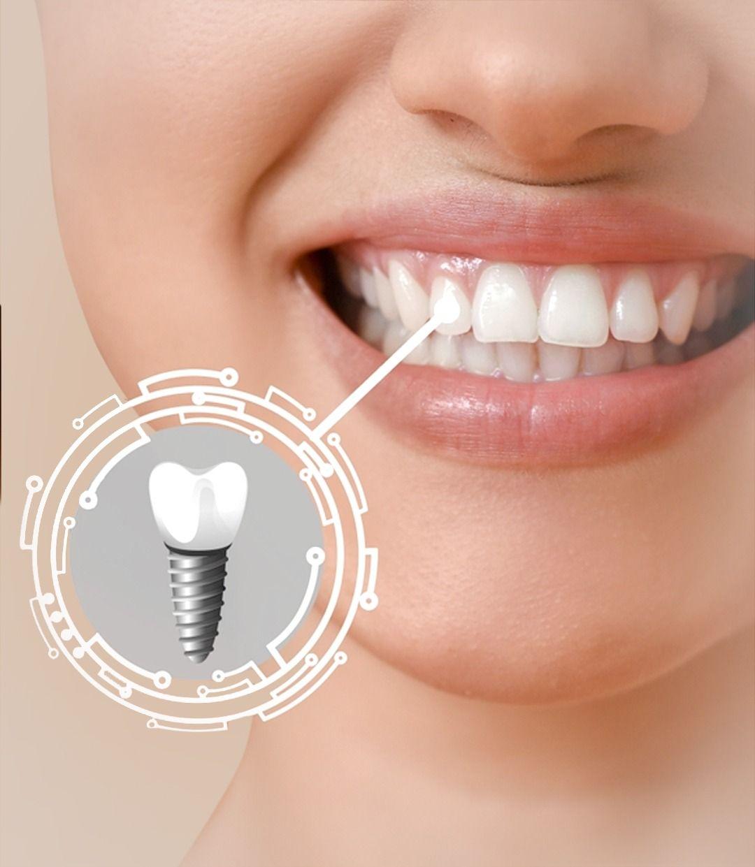 Teeth Implants