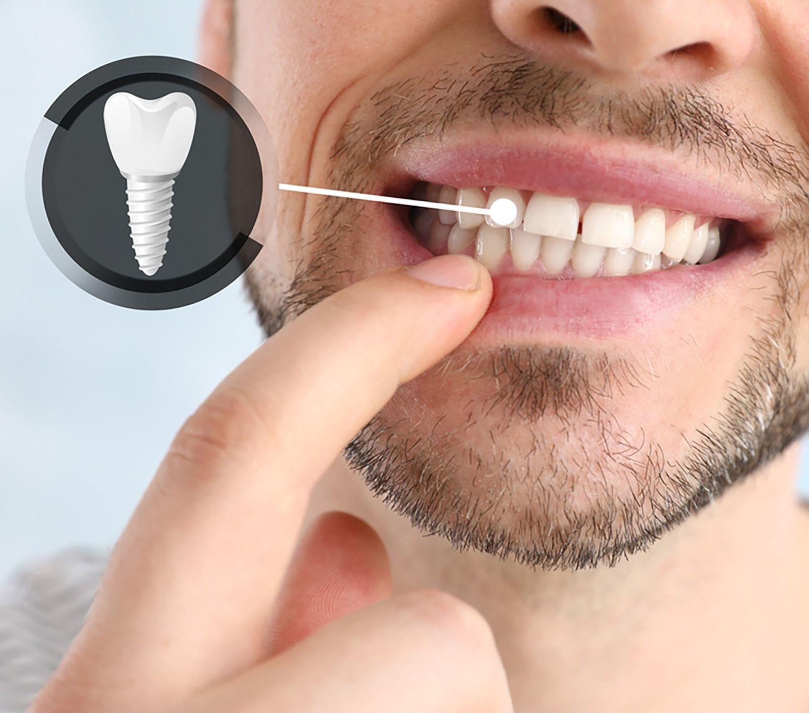 Teeth Implants