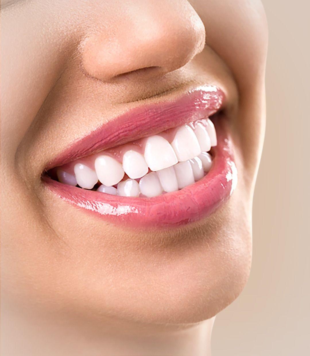 Teeth Whitening